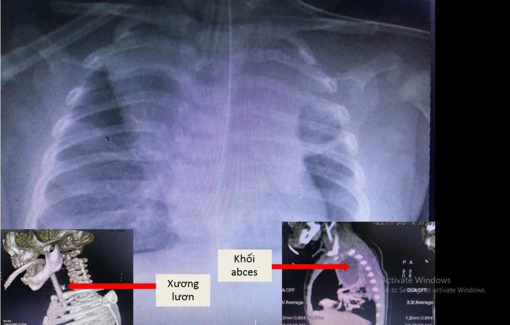 Bé trai thủng thực quản vì mẹ nấu cháo lươn cho ăn dặm ảnh 1