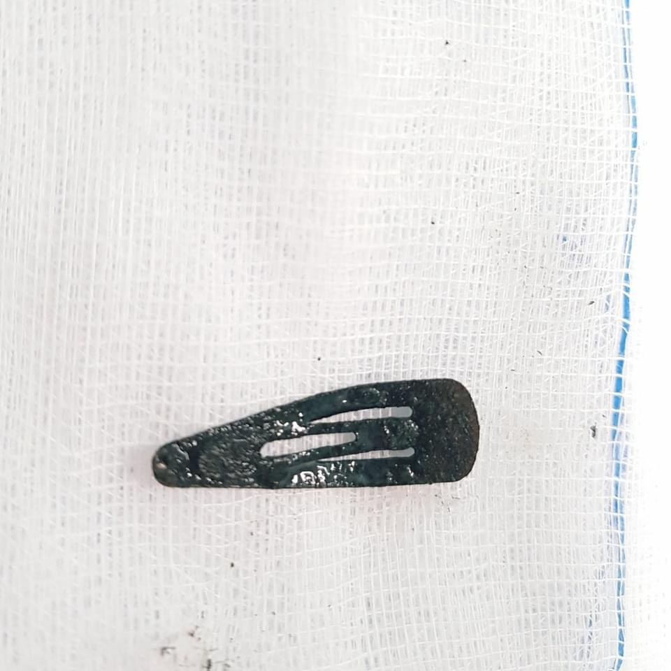 Kẹp tóc mắc kẹt trong cái âm đạo của bé gái suốt 3 tháng ảnh 2