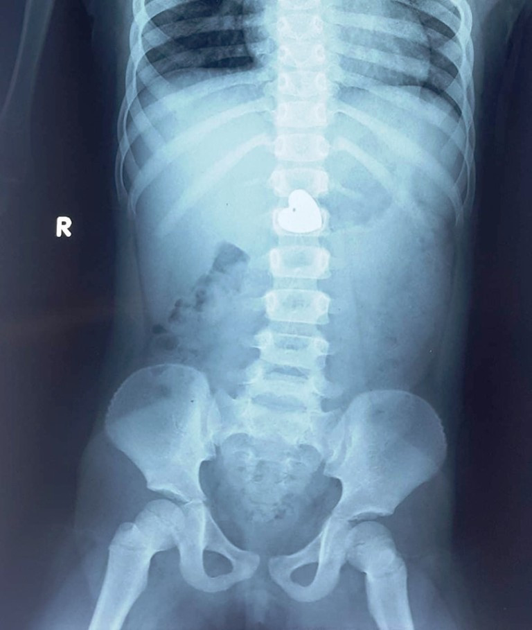 Cầm mặt dây chuyền chơi, bé gái nuốt luôn vào bụng ảnh 1