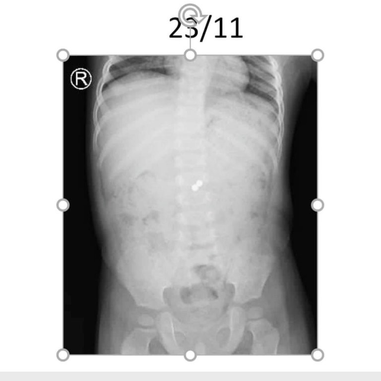 Ruột dính chặt vì hai viên bi nam châm ‘đi lạc’ trong bụng suốt 6 tháng ảnh 2