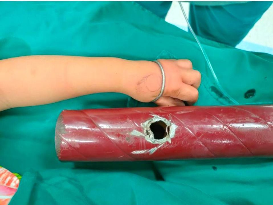 'Giải cứu' bé gái 3 tuổi kẹt cánh tay vào chân giường ảnh 2