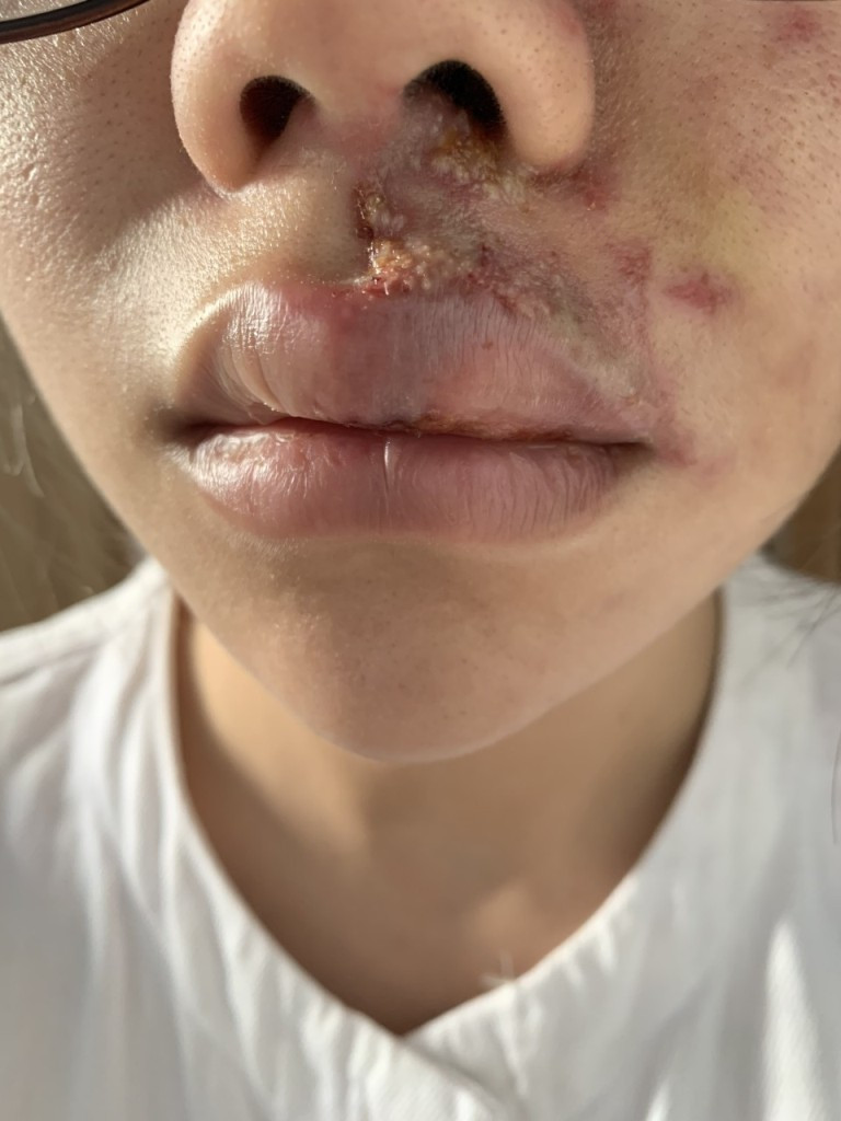 TPHCM: Cô gái trẻ sưng phù mặt khi tiêm filler làm đẹp ảnh 1