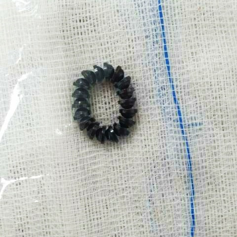 Nuốt 18 viên nam châm, bé trai 3 tuổi phải cắt nối ruột ảnh 3