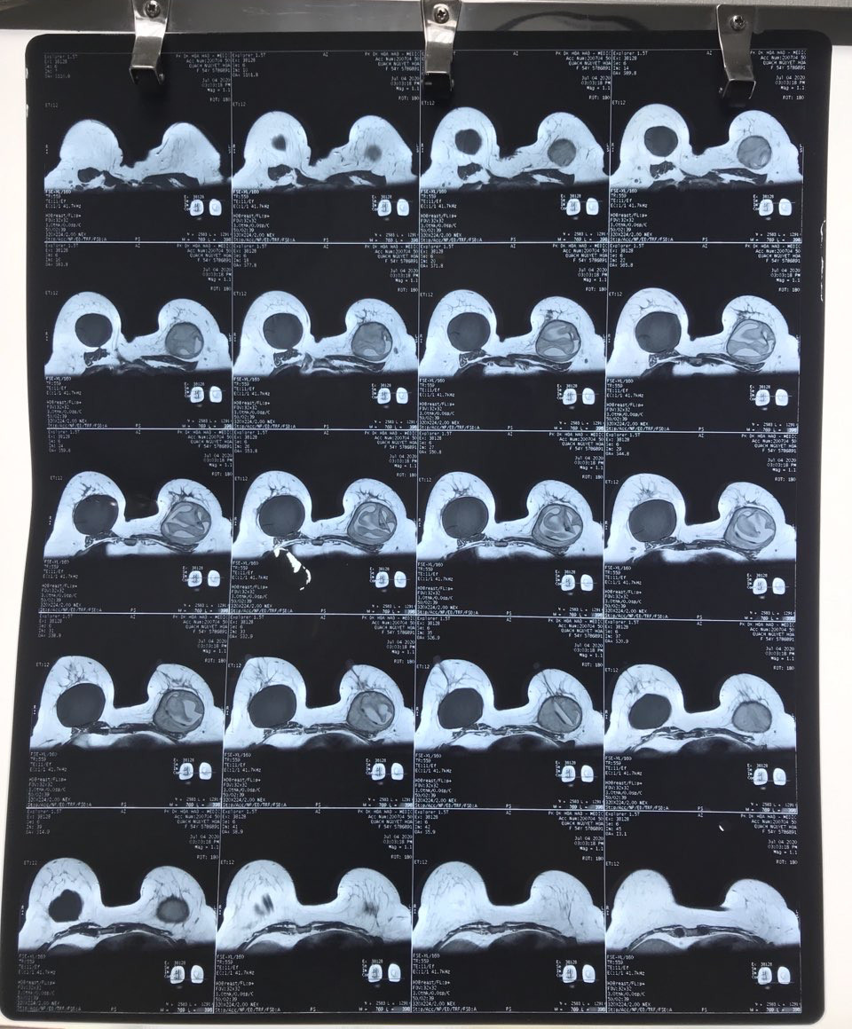 Nâng cấp làm đẹp 'vòng một', người phụ nữ bị vỡ túi ngực ảnh 1