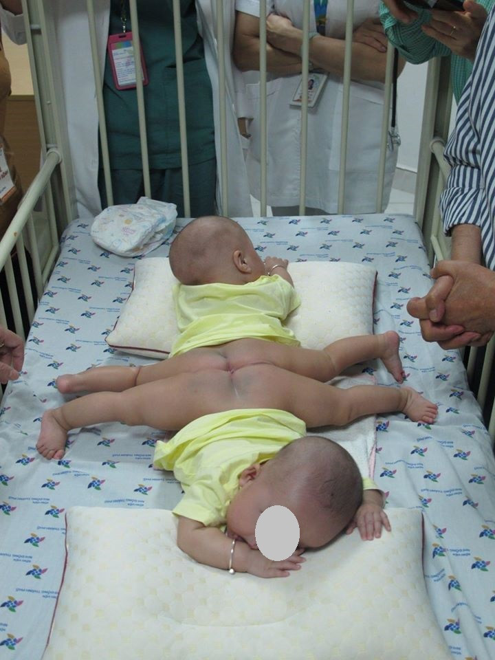 TPHCM: Chuẩn bị tách ca song sinh dính liền 'dùng chung một tã' ảnh 2