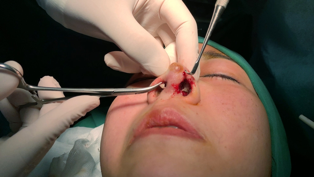 Nâng mũi ở spa, được 'khuyến mãi' thêm ổ áp-xe mông ảnh 1