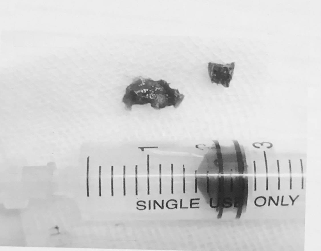 Mảnh xương gà 'dạo chơi' trong đường thở suốt 2 năm ảnh 2