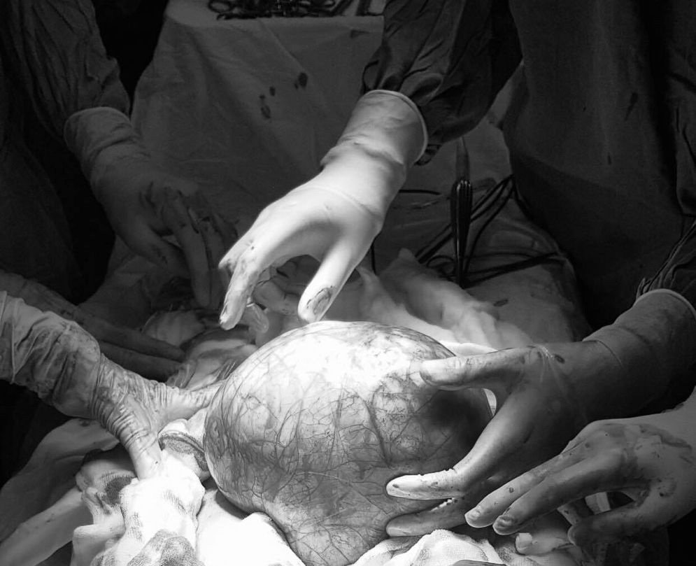 Sử dụng Testosterone trước khi chuyển giới, cô gái trẻ mang khối u to bằng quả dưa hấu ảnh 1