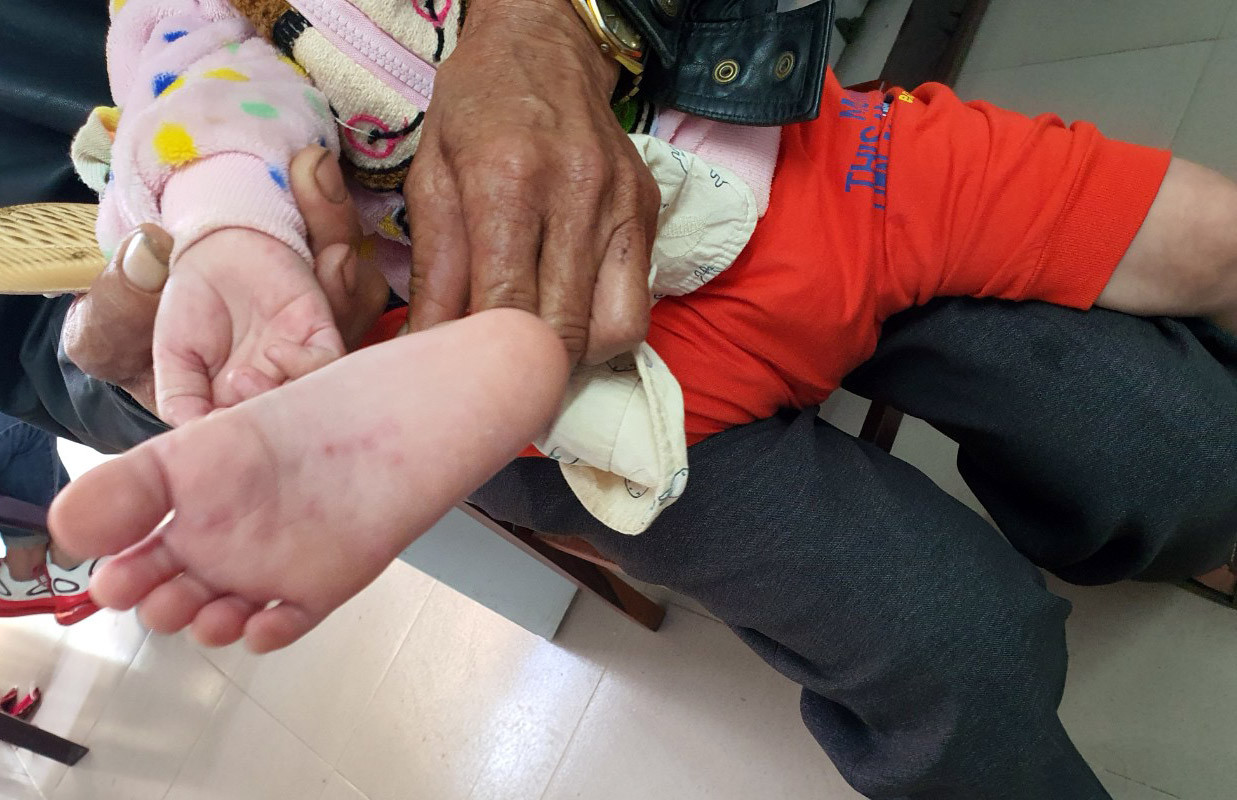 Lâm Đồng: Bùng phát bệnh tay chân miệng ở 1 trường mầm non ảnh 1