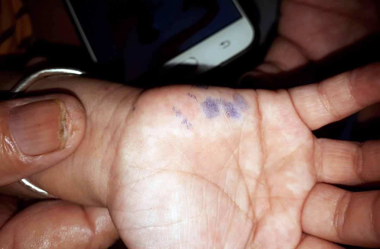 Lâm Đồng: Bùng phát bệnh tay chân miệng ở 1 trường mầm non ảnh 2