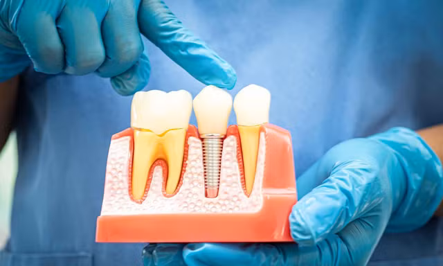 Bí quyết lựa chọn trụ implant phù hợp khi trồng răng