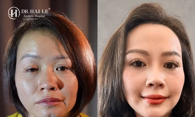Bệnh viện Hải Lê và hành trình 9 năm đồng hành cùng những ca mí lỗi, mí hỏng phức tạp