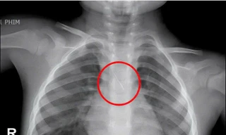 Kim chọc tủy rơi vào đường thở bé trai 3 tuổi khi làm răng