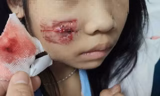 Cháu bé bị khỉ hoang tấn công khi chơi ở sân nhà