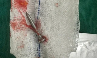 Người đàn ông ở Quảng Trị bị súng bắn đinh xuyên thủng ruột non