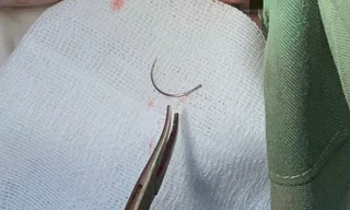 Kim khâu bị ‘bỏ quên’ trong cơ thể người phụ nữ suốt 11 năm