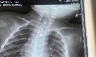 Trẻ bị thủng tá tràng vì nuốt que kẹo mút