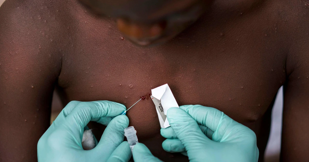 Kachu Infection Bệnh đậu mùa khỉ lan nhanh ở châu Âu, WHO họp khẩn