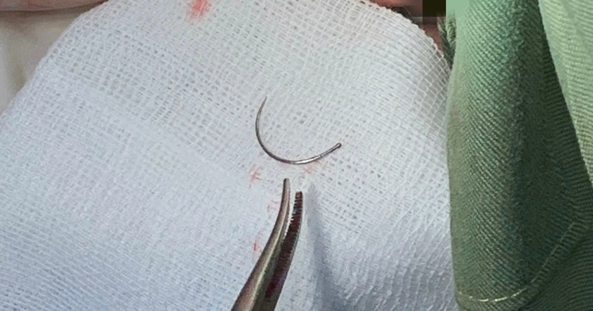 Kim khâu bị ‘bỏ quên’ trong cơ thể người phụ nữ suốt 11 năm