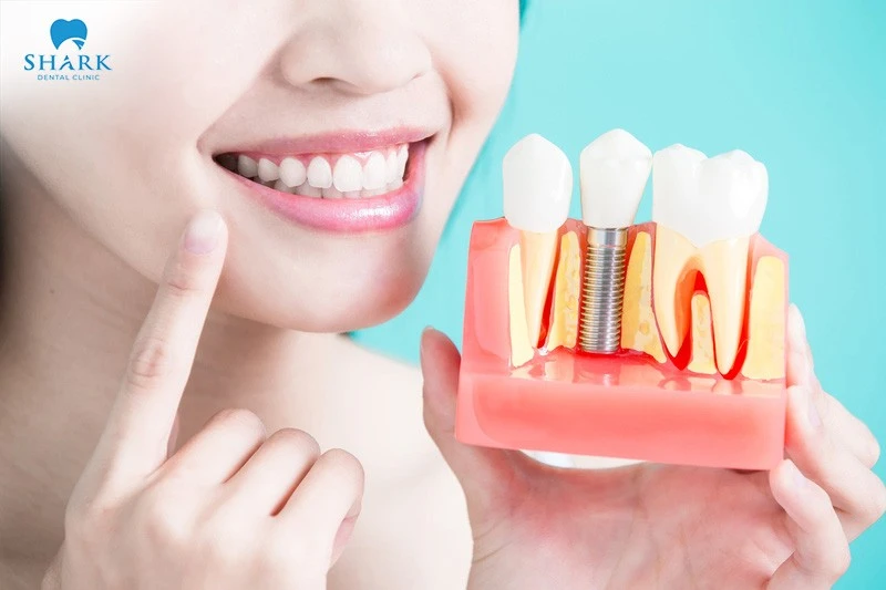 Những thông tin quan trọng về cấy ghép Implant