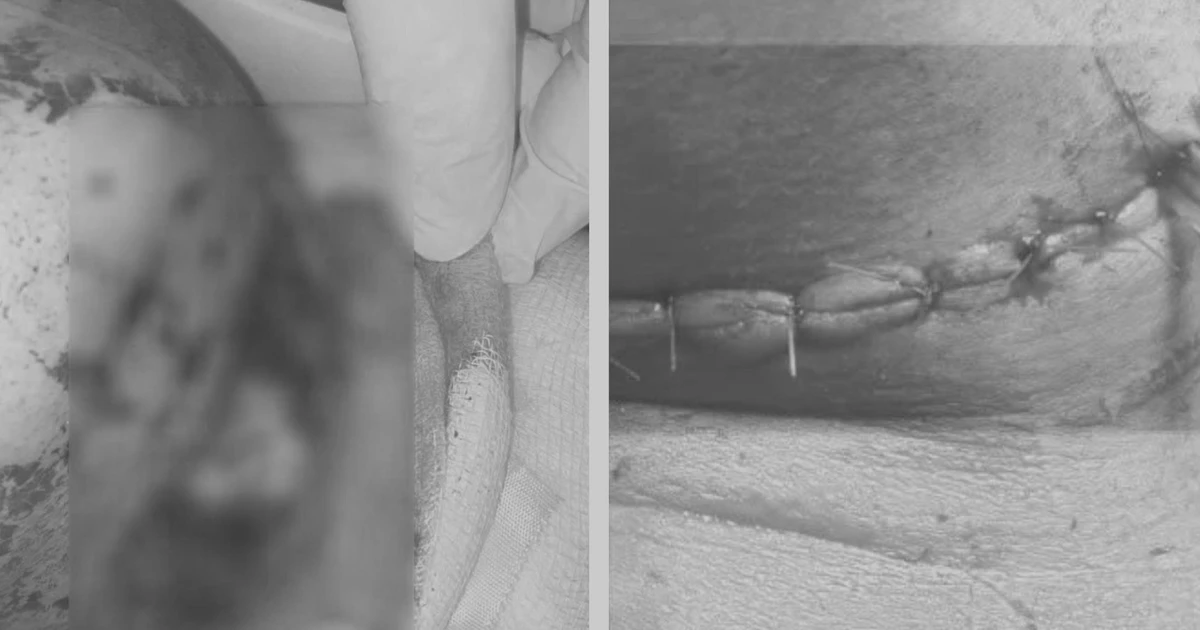 Đi xe máy bị tre ven đường cứa sâu vào cổ