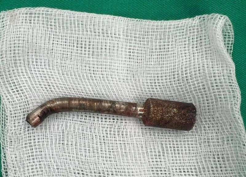 Thanh Hóa: Vận hành máy khoan đá, một công nhân bị mũi khoan găm sâu trong mũi