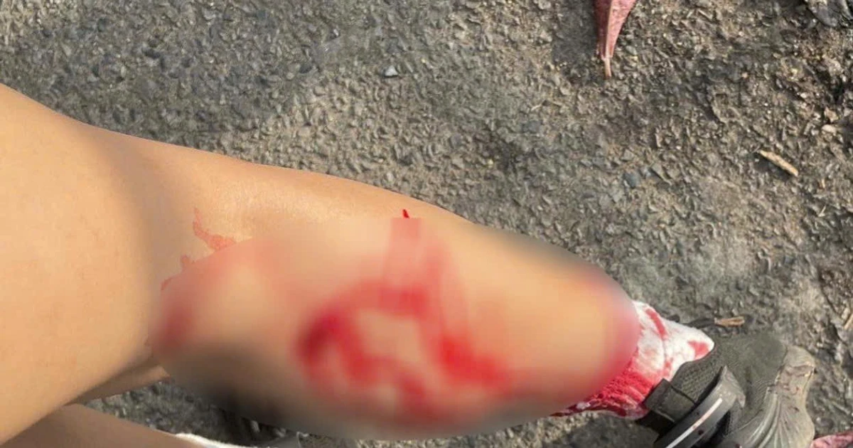 Khỉ hoang tấn công gây thương tích cho người dân ở Vũng Tàu