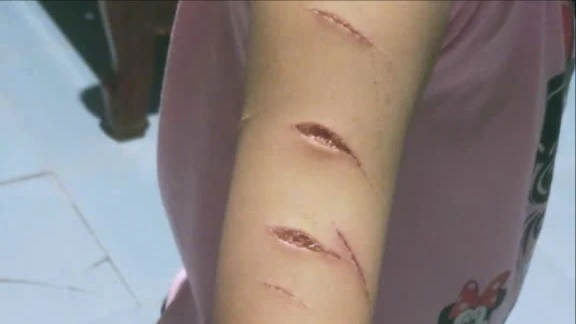 Hé lộ nguyên nhân học sinh lớp 5 bị chị họ dùng dao rạch nhiều nhát lên tay