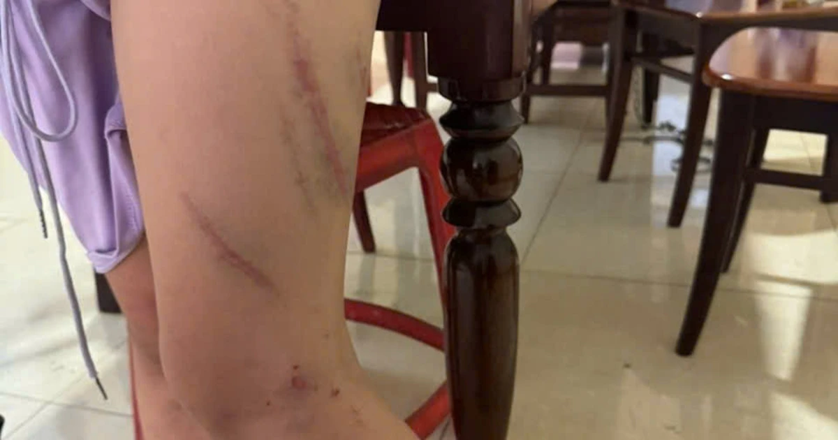 Bé gái 9 tuổi chi chít vết bầm trên cơ thể, nghi bị mẹ bạo hành