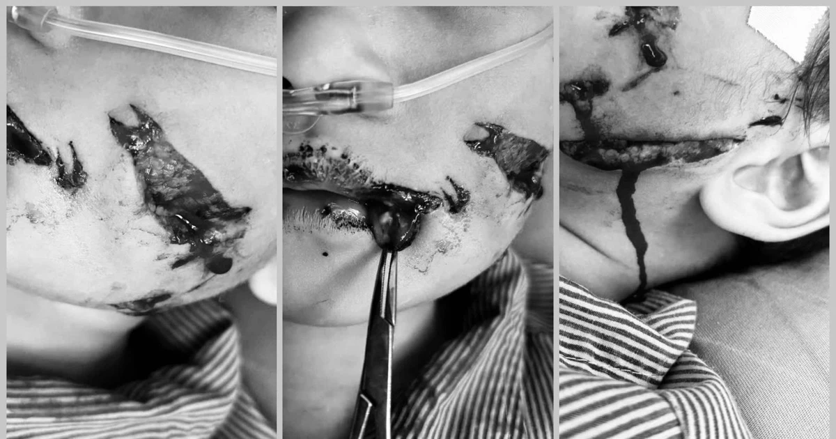 Cháu bé 5 tuổi bị chó cắn rách mặt khi đang chơi ở nhà