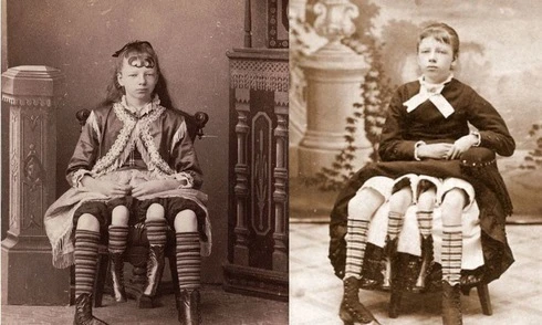 Người đàn bà 4 chân khiến y học bối rối | Báo điện tử Tiền Phong