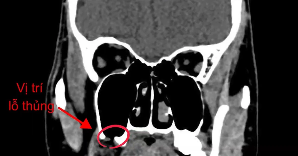 Nhổ 'răng khôn', người đàn ông bị đục thủng xoang hàm