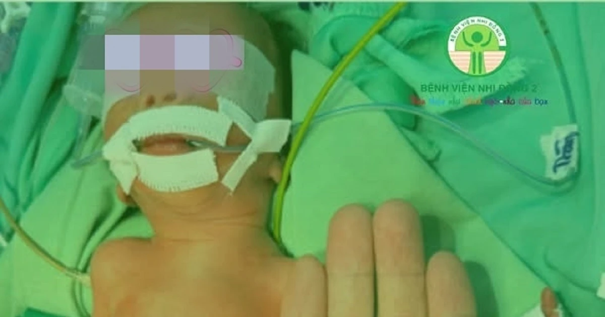 ‘Nhường’ máu nuôi người anh song thai, bé trai sinh non nguy kịch