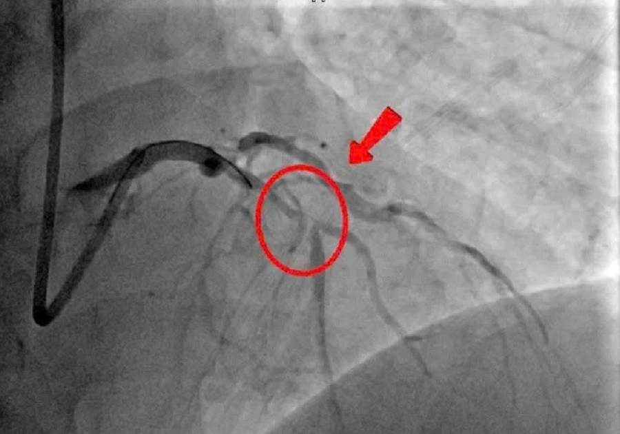 May mắn thoát chết khi bị nhồi máu cơ tim cấp tại bệnh viện