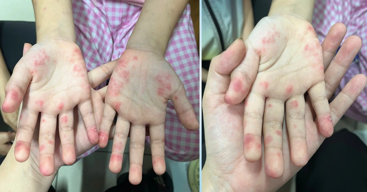 Bệnh nhi hai lần bị chẩn đoán nhầm vì căn bệnh tự miễn ‘giấu mặt’