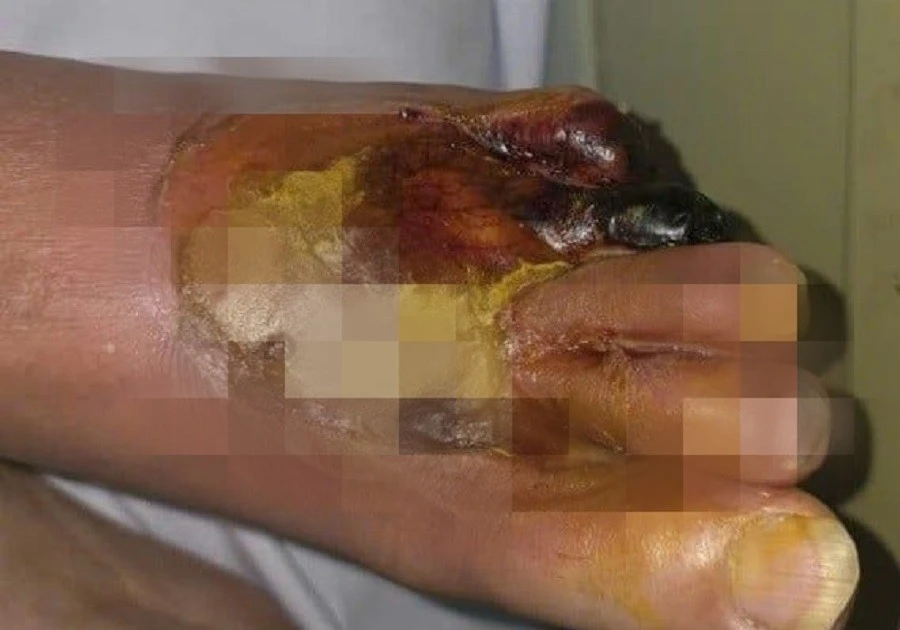 Bàn chân bị cháy đen vì sưởi ấm bằng máy sấy tóc