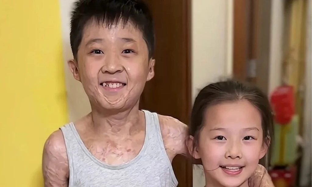 Cậu bé bỏng 97% cơ thể và giấc mơ thành nhà vô địch cầu lông