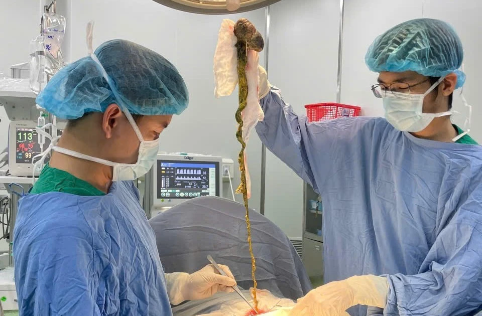Lấy búi tóc khổng lồ ra khỏi dạ dày bé trai ở Đà Nẵng