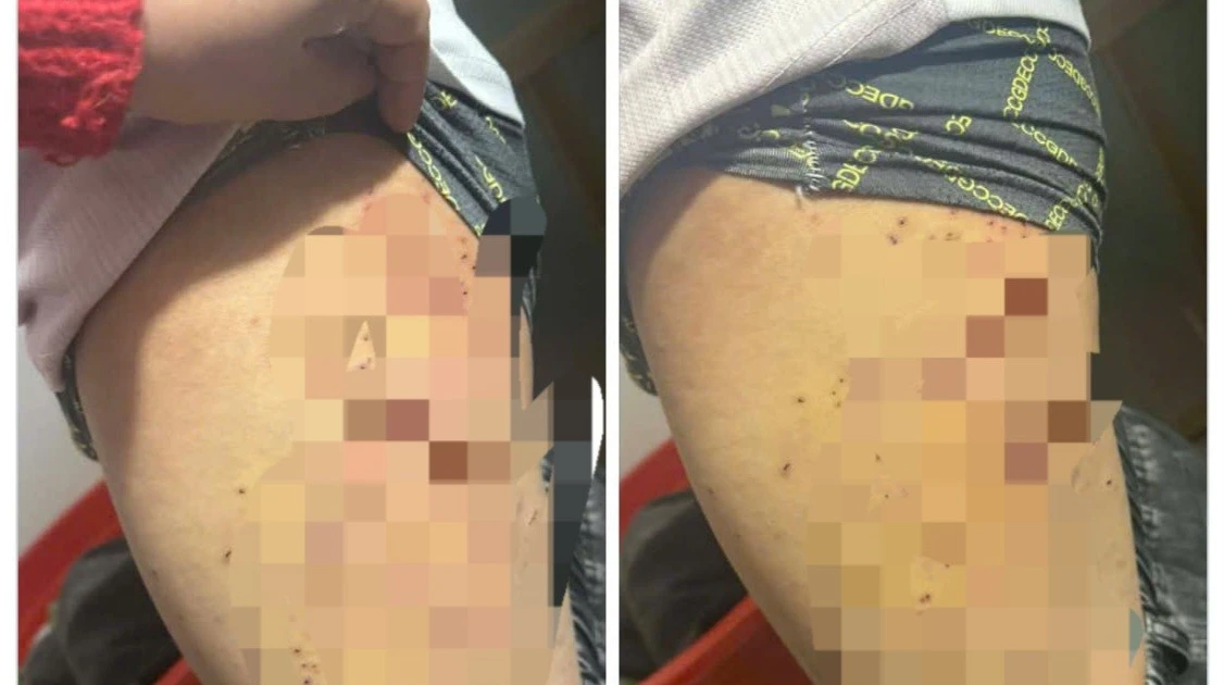 Nữ sinh lớp 7 bị bạn dùng bút bi đâm chi chít vào đùi