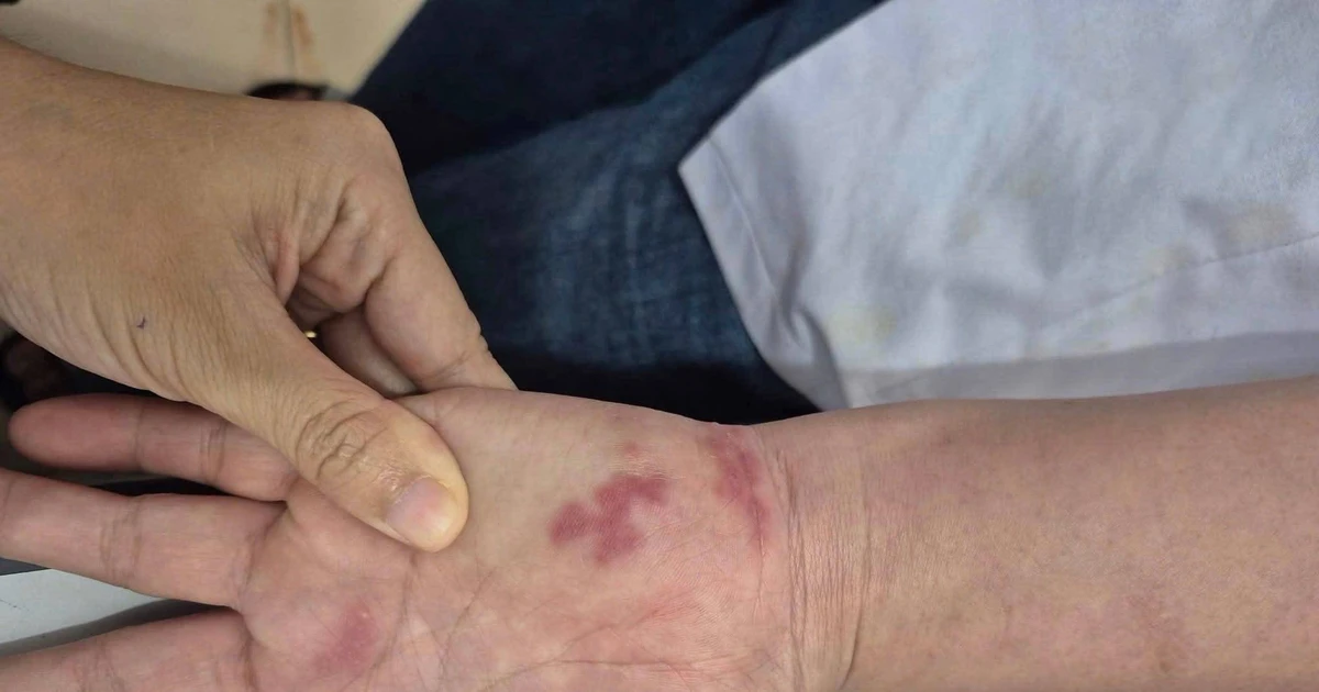 Cụ ông 70 tuổi nhiễm vi khuẩn ‘ăn thịt người’ khi bị vây cá đâm vào tay