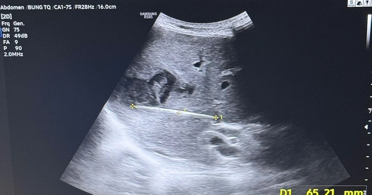 Nguy kịch tính mạng vì thói quen phổ biến sau bữa ăn của người Việt