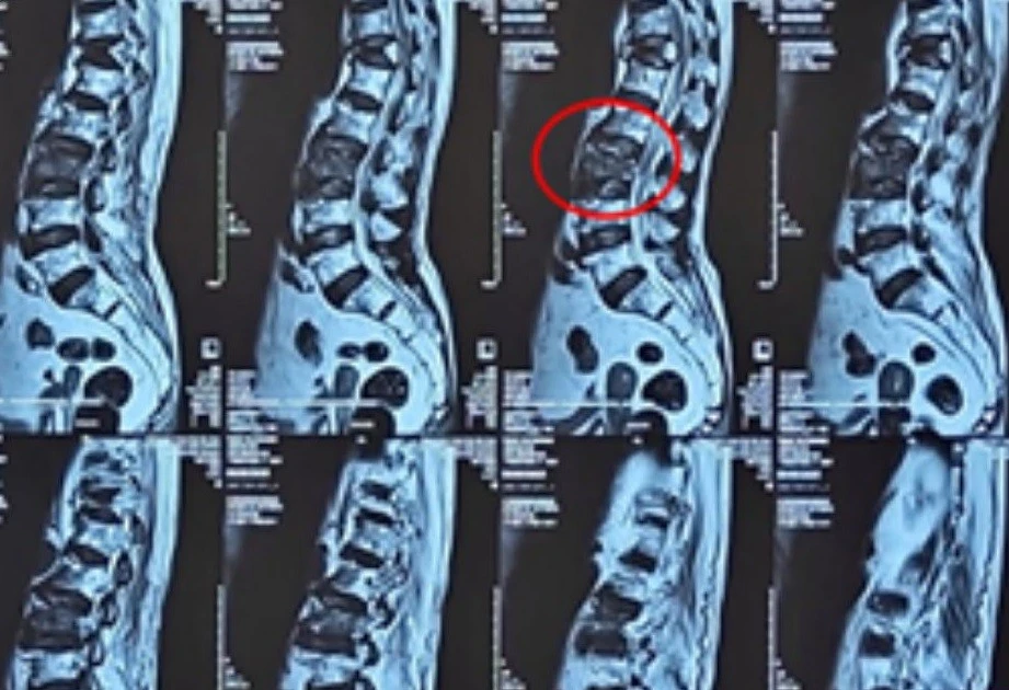 Bơm ‘xi măng’ vào đốt sống cứu cụ bà 100 tuổi