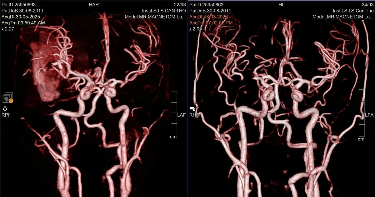 Cứu sống nam sinh hôn mê sâu do vỡ mạch máu não