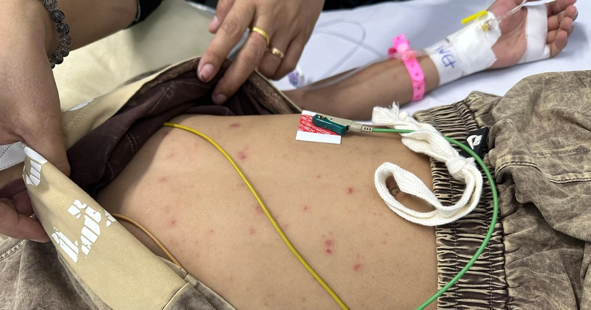 Bé trai mắc não mô cầu thoát chết nhờ phát hiện nốt ‘tử ban’ trên da
