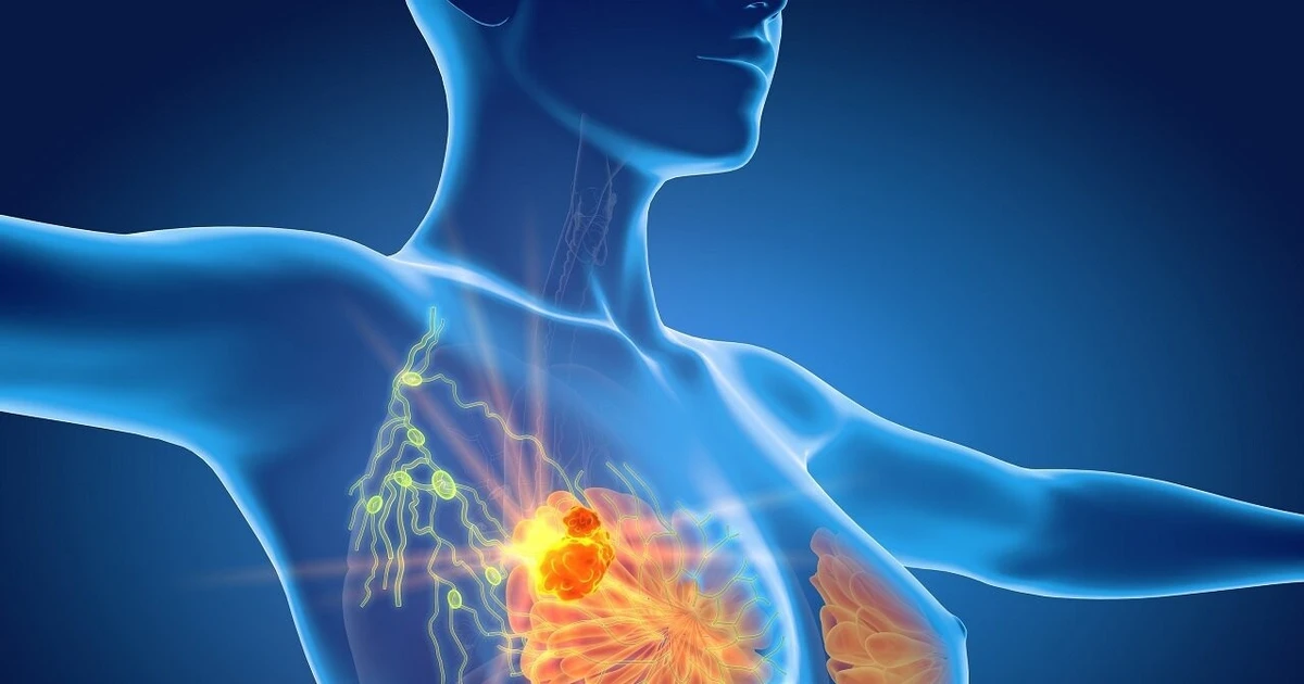 Phát hiện đột biến gen di truyền trên bệnh nhân ung thư vú