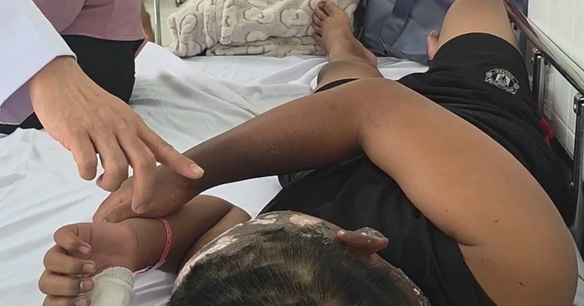 Ám ảnh tai nạn pháo, một tiếng nổ hủy hoại cả cuộc đời