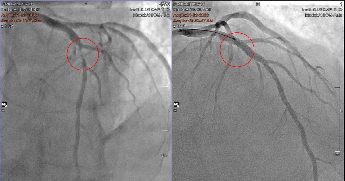 Cứu bệnh nhân quốc tịch Pháp khỏi nguy cơ đột tử ở phút 89