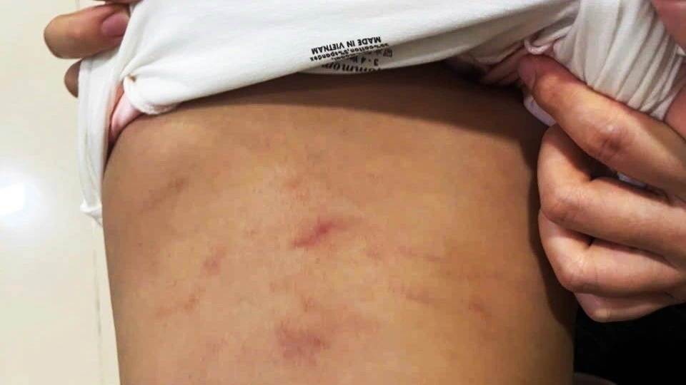 Làm rõ vụ cháu bé 2 tuổi ở Cà Mau nghi bị bạo hành tại lớp trông trẻ