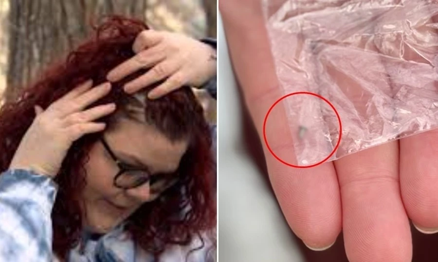 Bác sĩ không tin, bệnh nhân ở Canada đành tự rút "vật thể lạ" nổi dưới da đầu