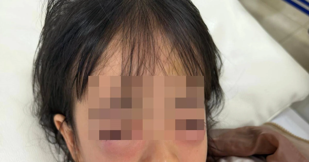 Bé gái 5 tuổi nhập viện, mắt sưng vù sau khi chơi bong bóng xà phòng